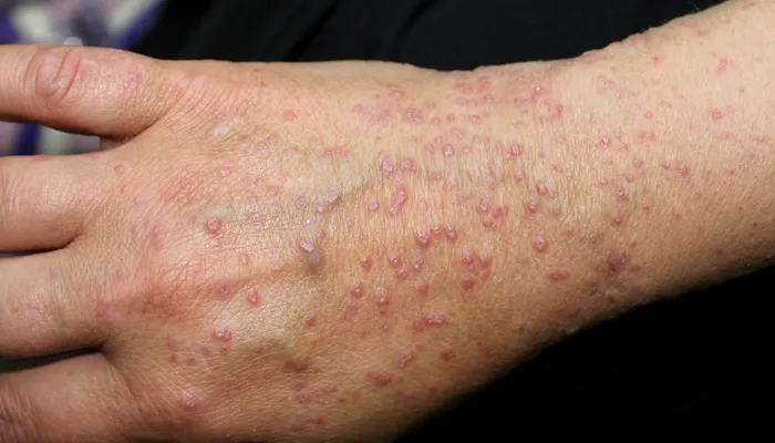 Lichen Planus