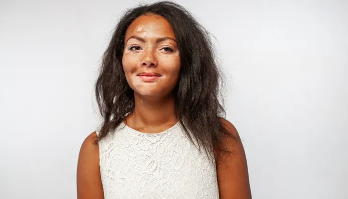 Vitiligo