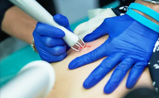 Image of Scar Revision Surgery Section 2
