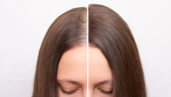 Patients Seeking Hair Restoration