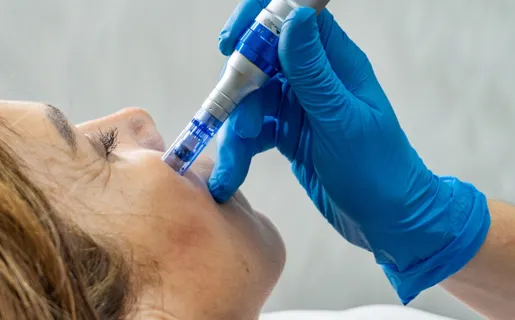 Microneedling